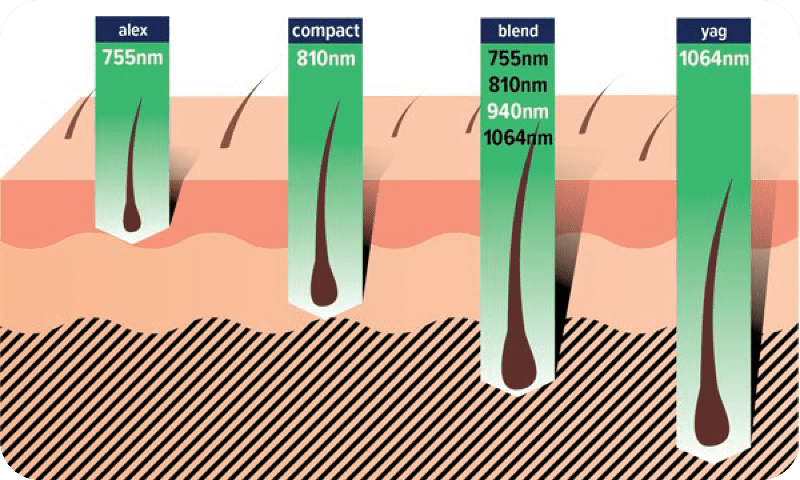 4種類のレーザー深達度の違いを表現する皮ふの断面図